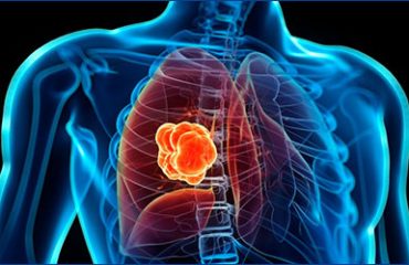 Akciğer Kanseri Tedavisinde Yenilikler