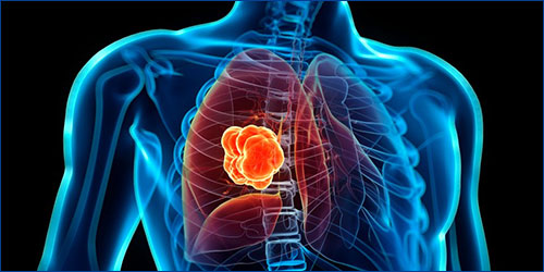 Akciğer Kanseri Tedavisinde Yenilikler